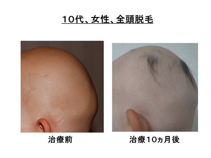 円形脱毛症　病院